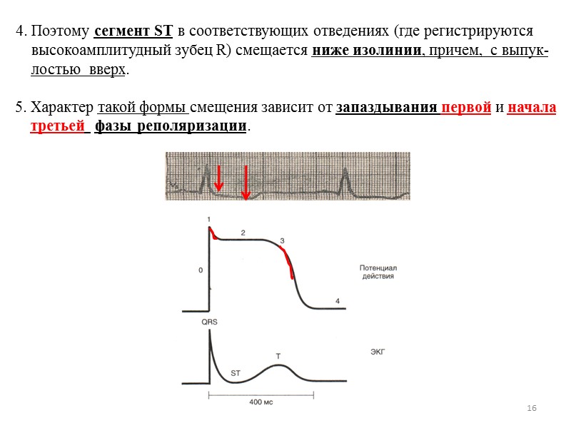 16 4. Поэтому сегмент ST в соответствующих отведениях (где регистрируются 16 4. Поэтому сегмент ST в соответствующих отведениях (где регистрируются